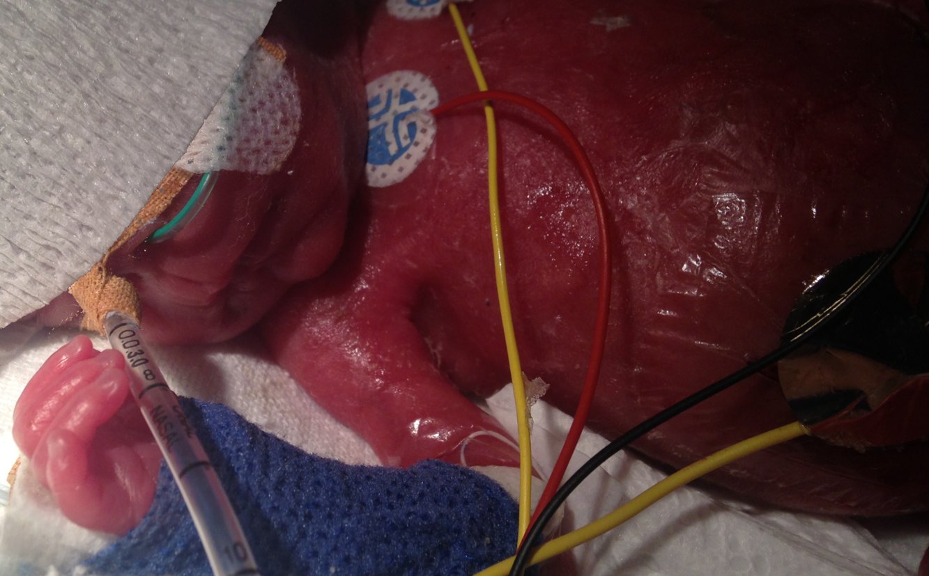 Intubation of a premature infant born at 23 weeks of gestation