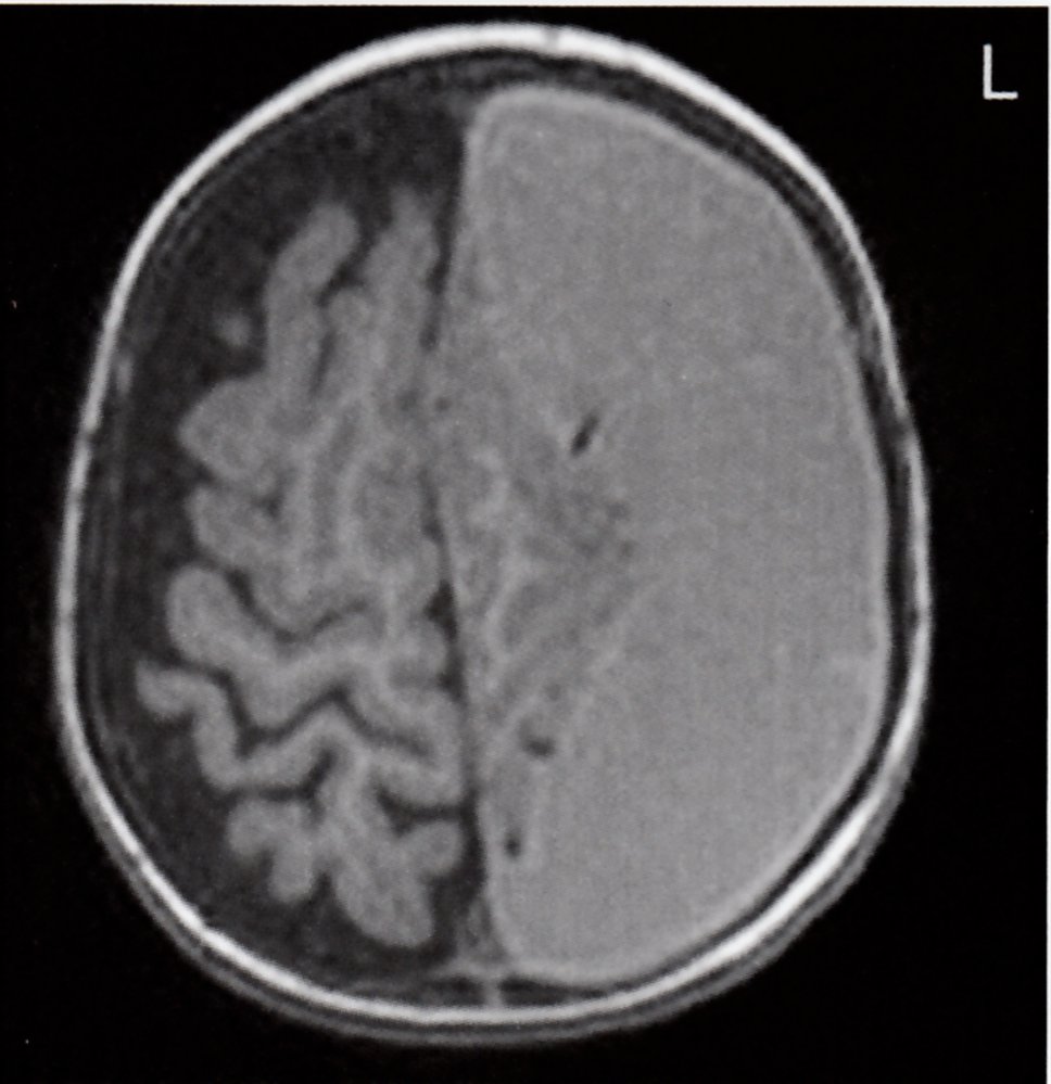 Subacute subdural hematoma and subdural hygroma (2/2)