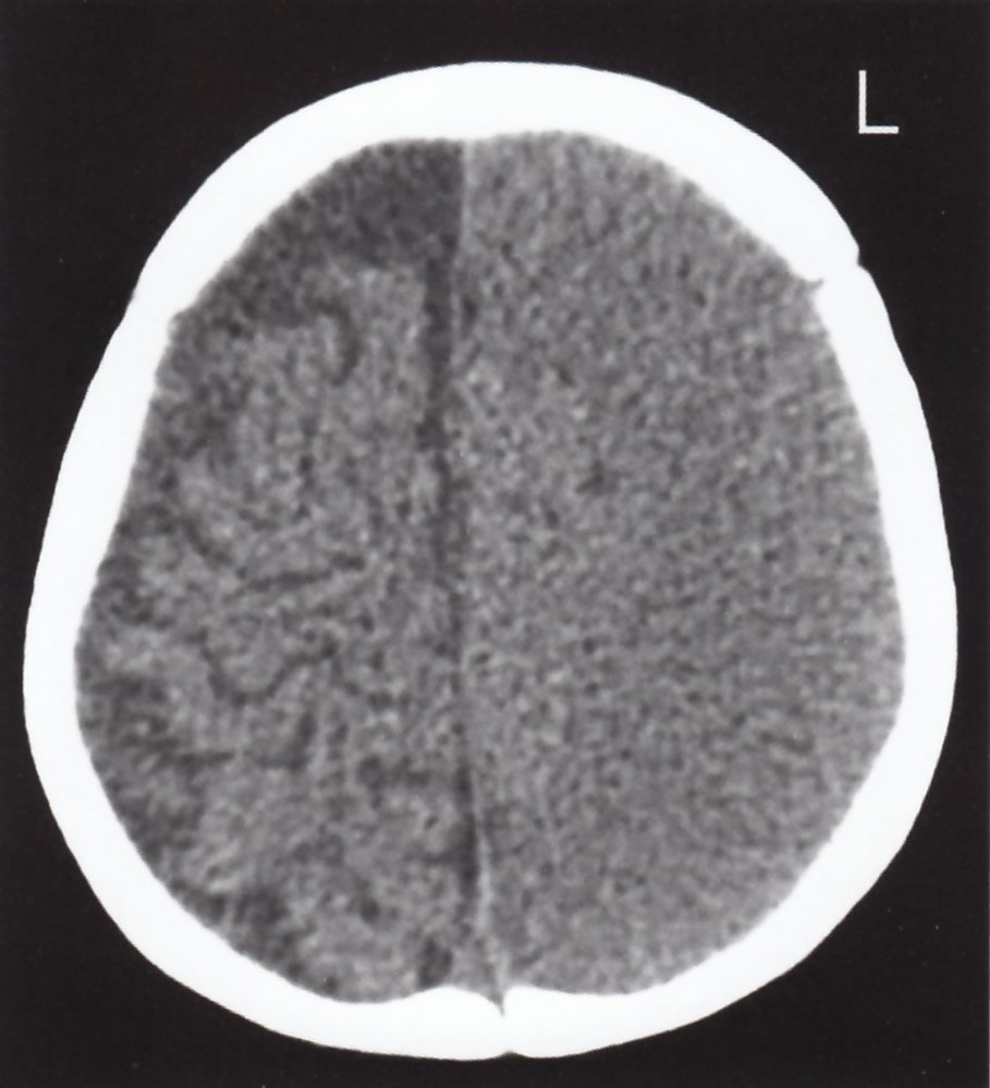 Subacute subdural hematoma and subdural hygroma (1/2)