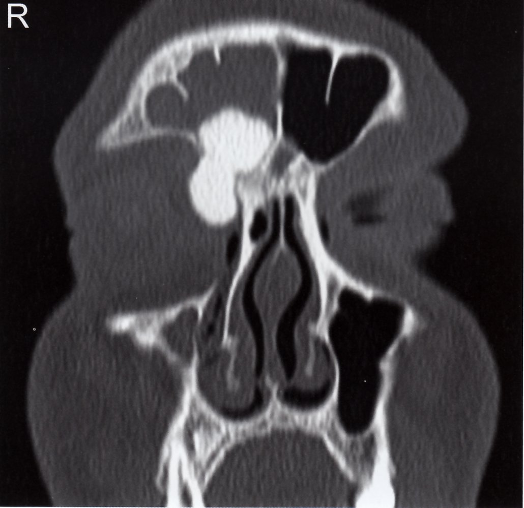 Osteoma of the frontal sinus