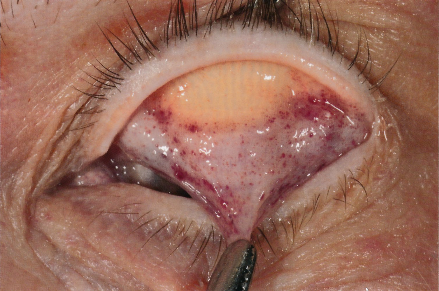Petechiae of the conjunctiva after violent asphyxiation
