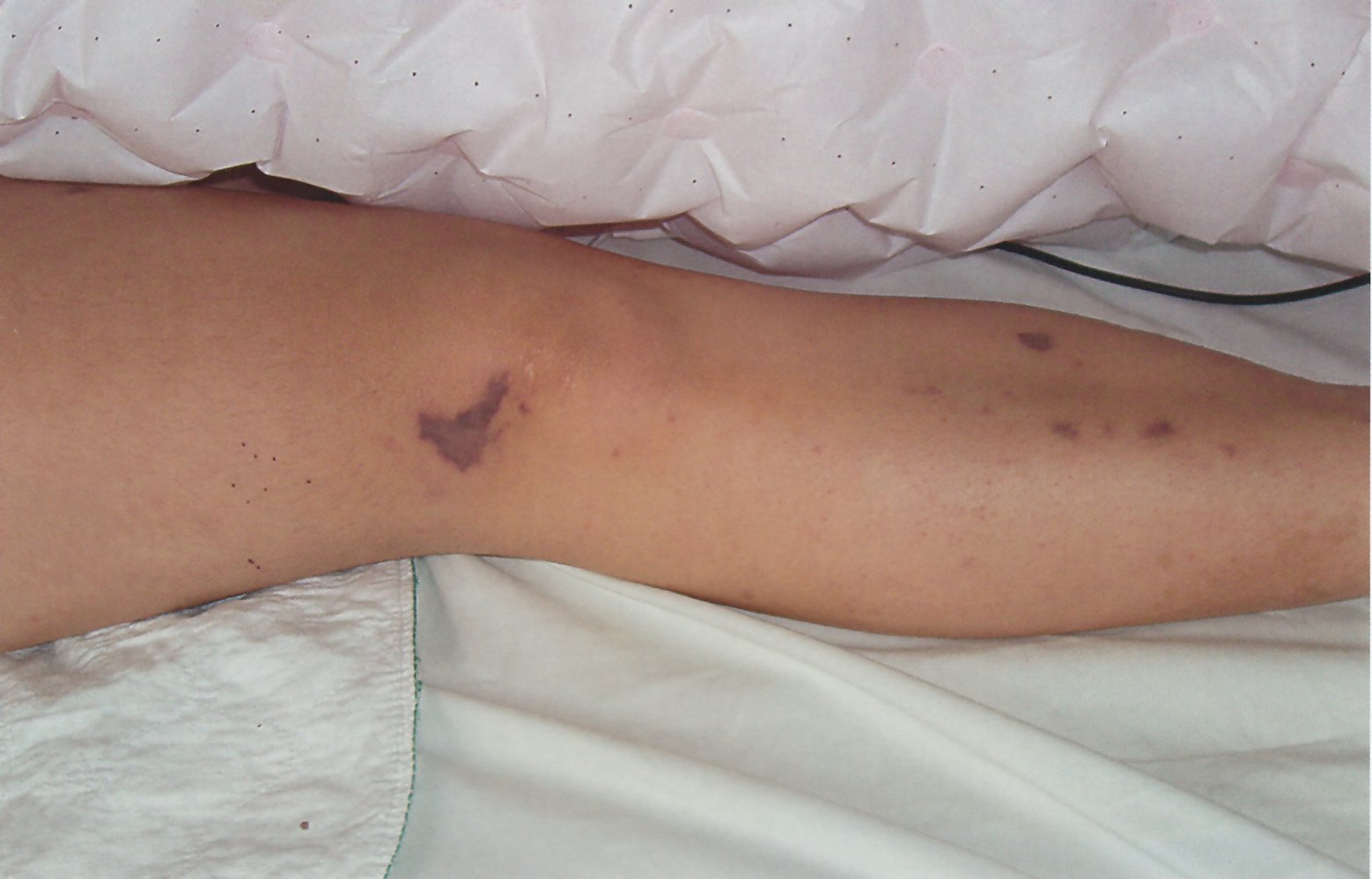 Skin hemorrhages in Waterhouse-Friderichsen syndrome