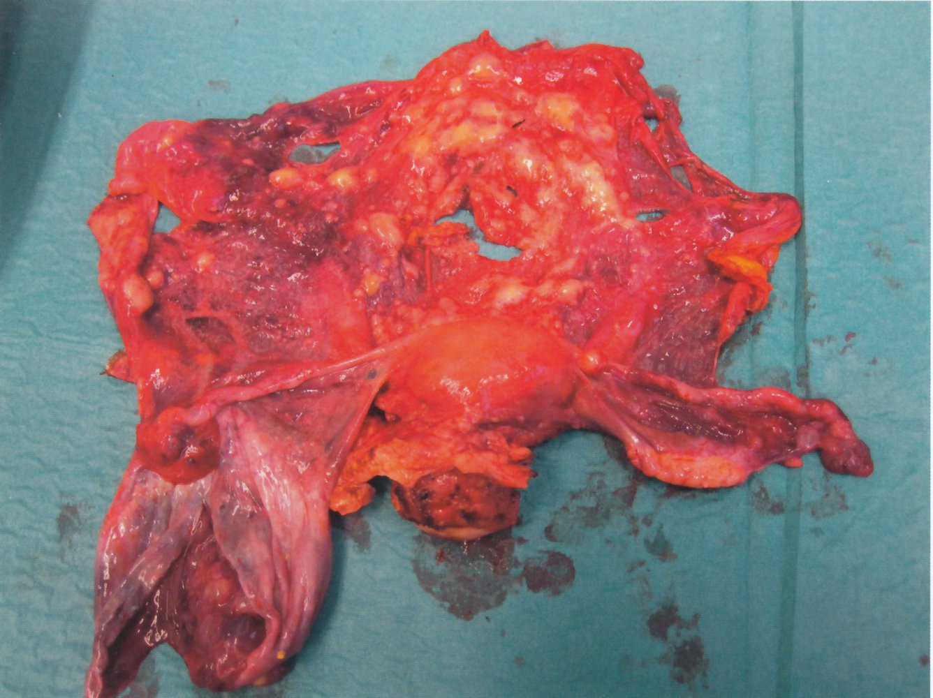 Radical surgical staging of progressive serous ovarian cancer