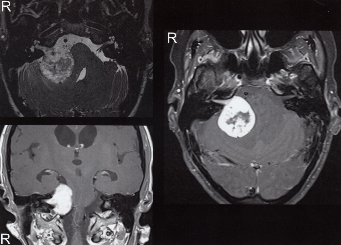 Vestibularis schwannoma (acoustic neuroma)