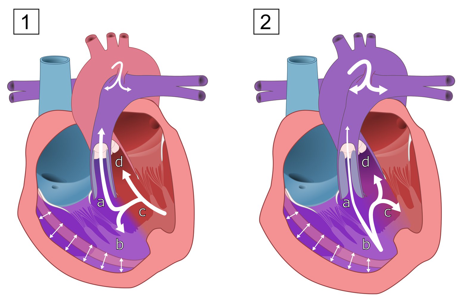 Tetralogy of Fallot