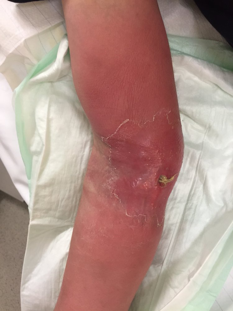 Skin abscess and phlegmon