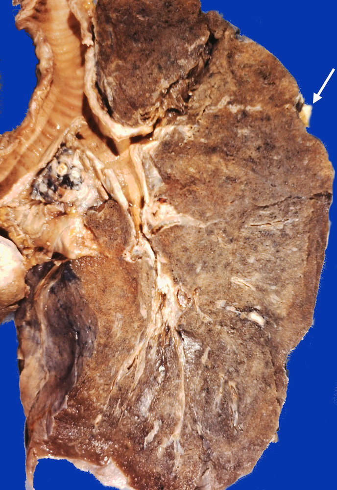 Ranke complex in tuberculosis