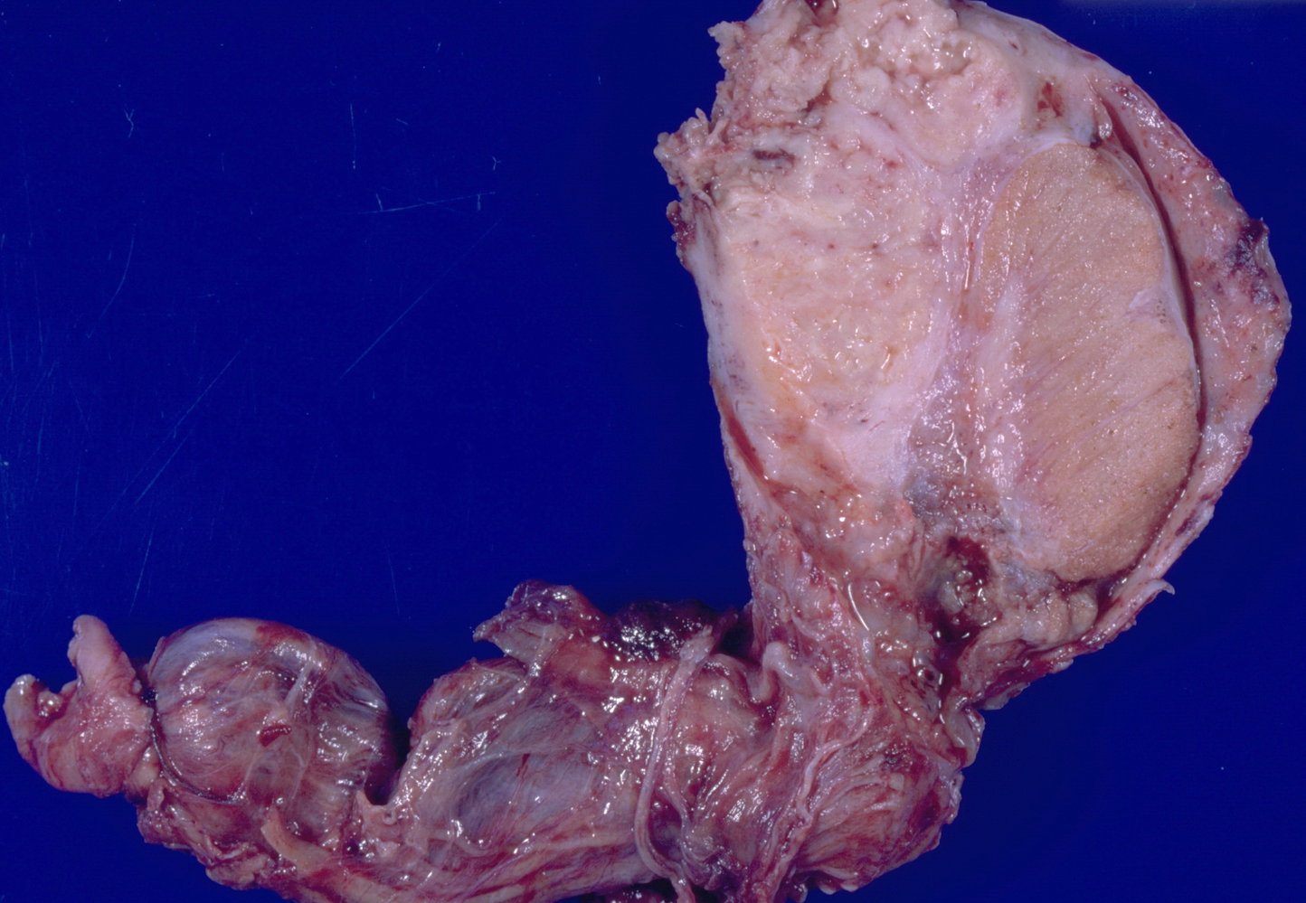 Tuberculous epididymitis and orchitis (urogenital tuberculosis)