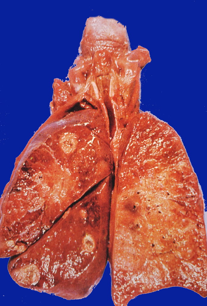 Pulmonary manifestation of granulomatosis with polyangiitis