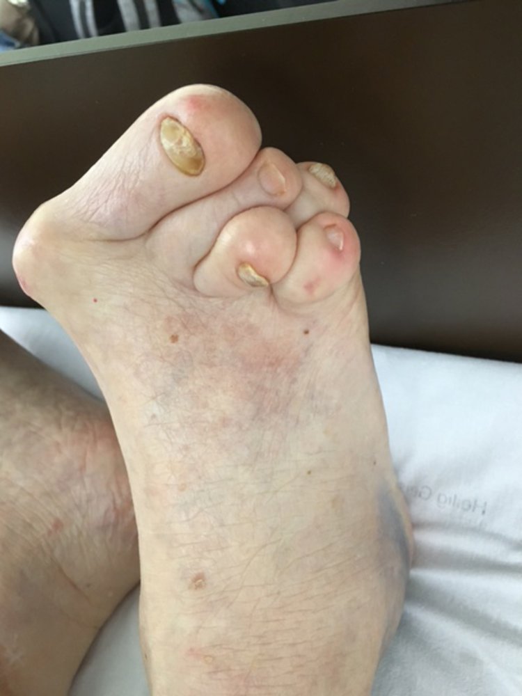 Rheumatoid foot
