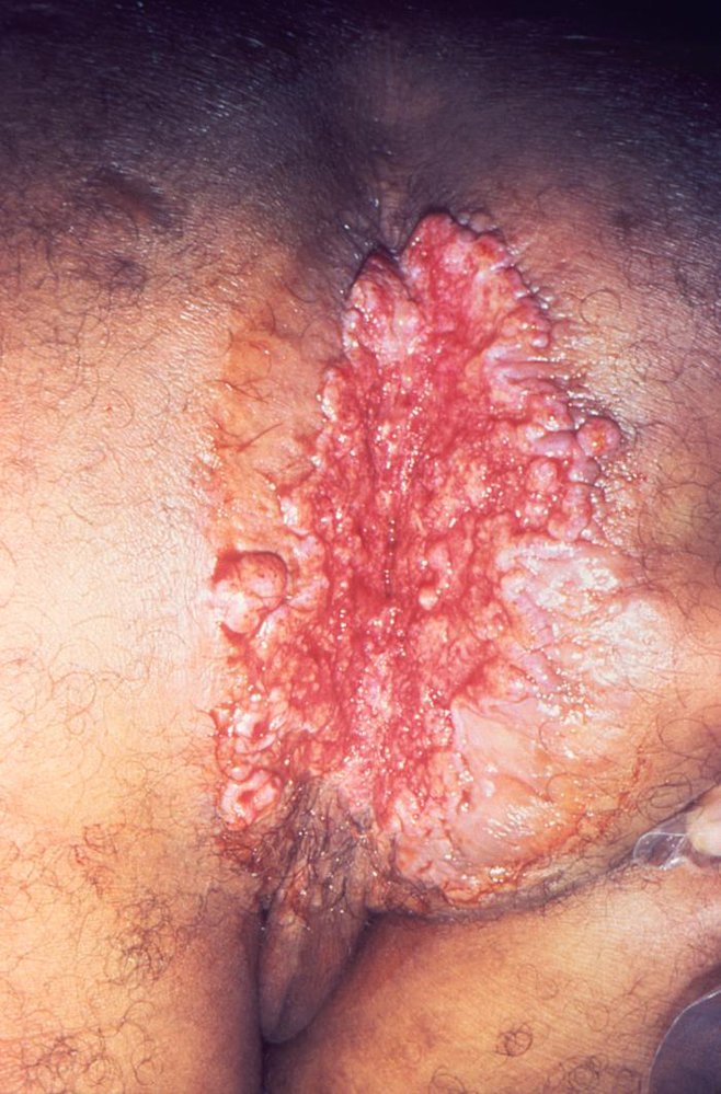 Granuloma inguinale