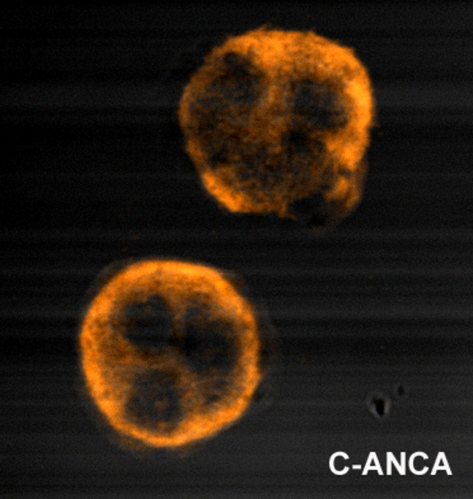 Cytoplasmic pattern of antineutrophil cytoplasmic antibodies (c-ANCA)