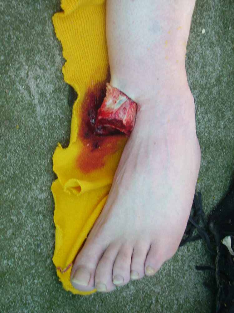 Open fracture of the left ankle