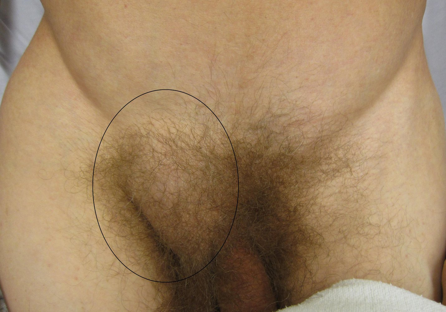 Inguinal hernia