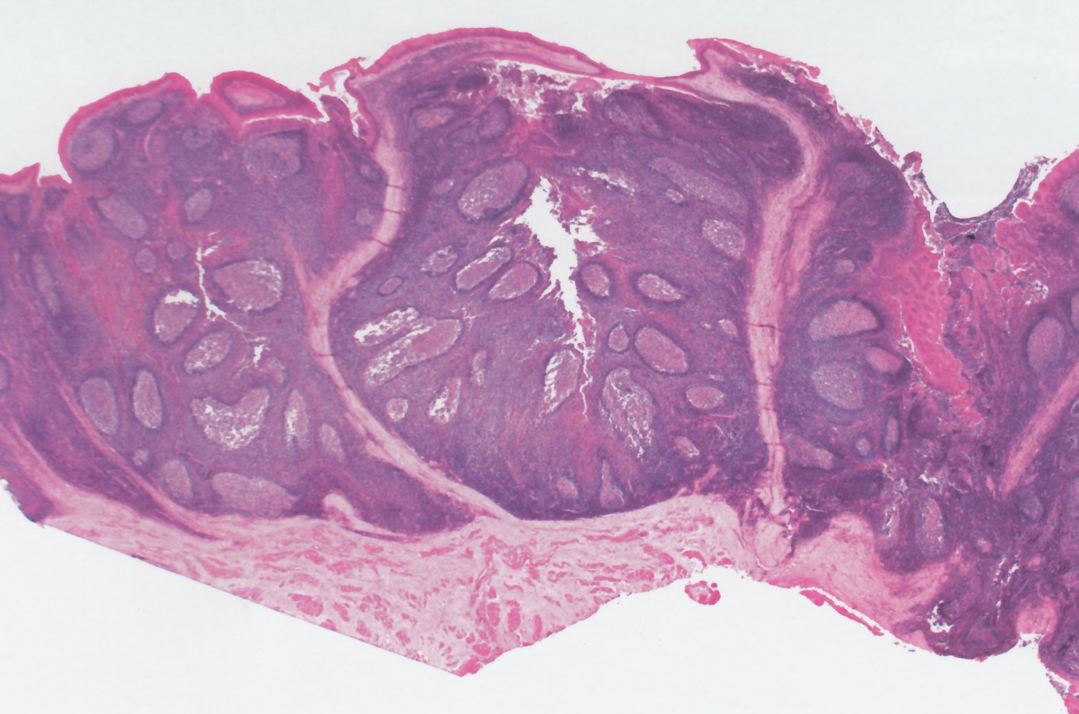 Palatine tonsil