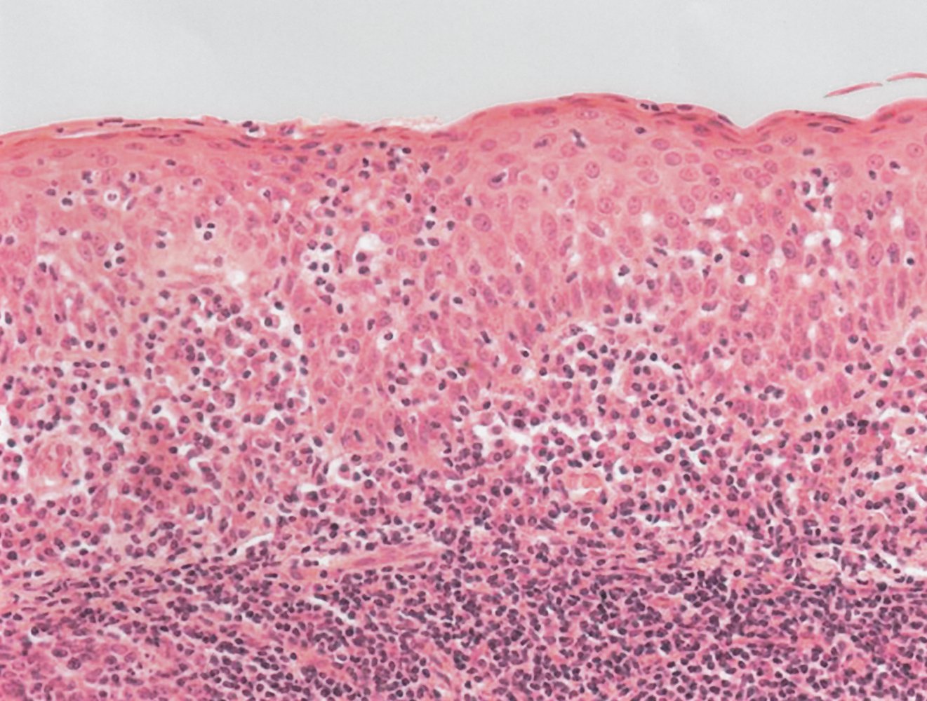 Palatine tonsil