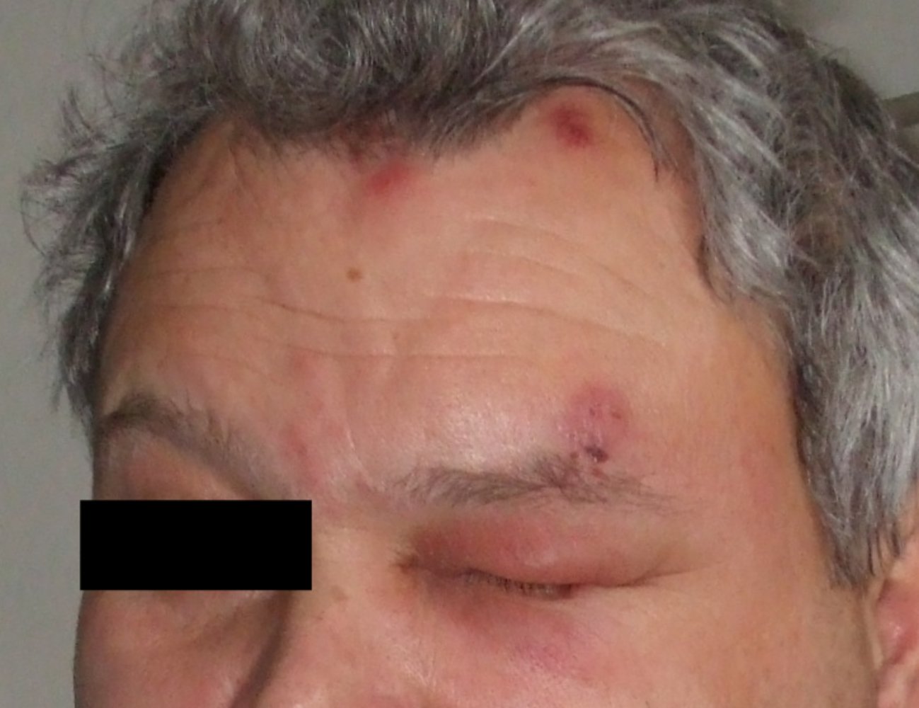 Herpes zoster ophthalmicus