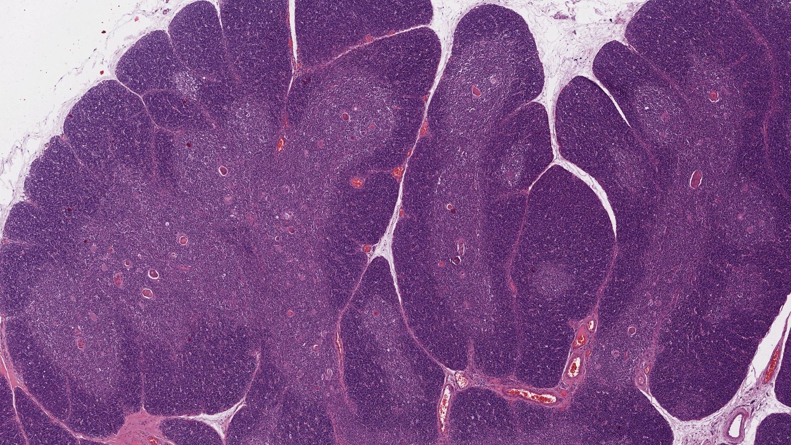 Thymus (child)