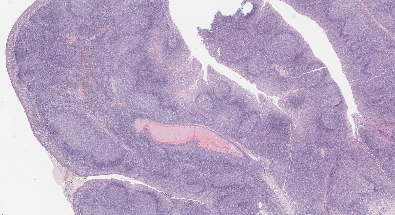 Palatine tonsils