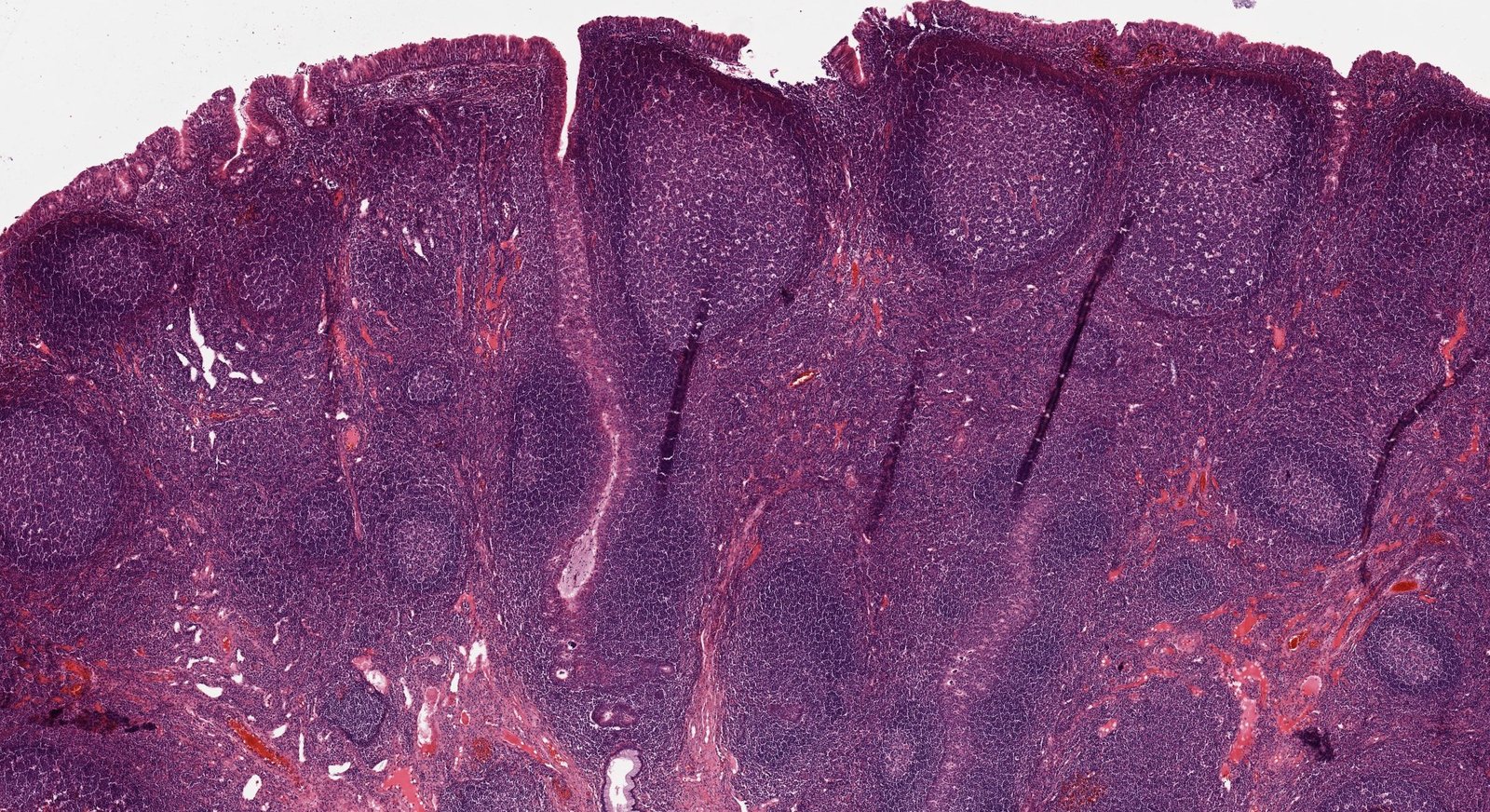 Adenoid