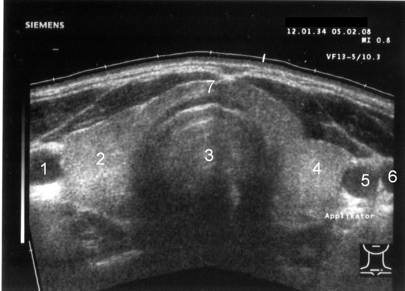 Normal thyroid