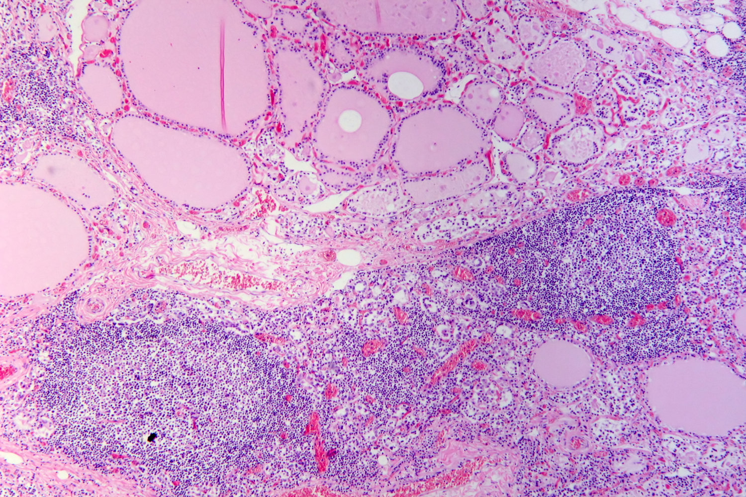 Hashimoto thyroiditis