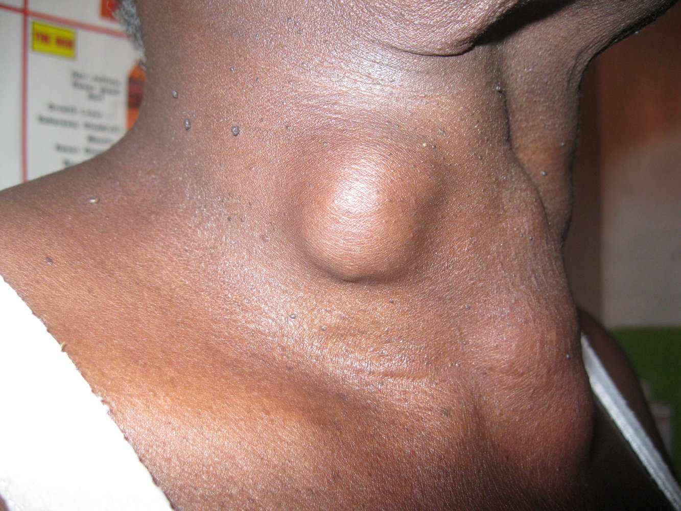 Thyroid cancer