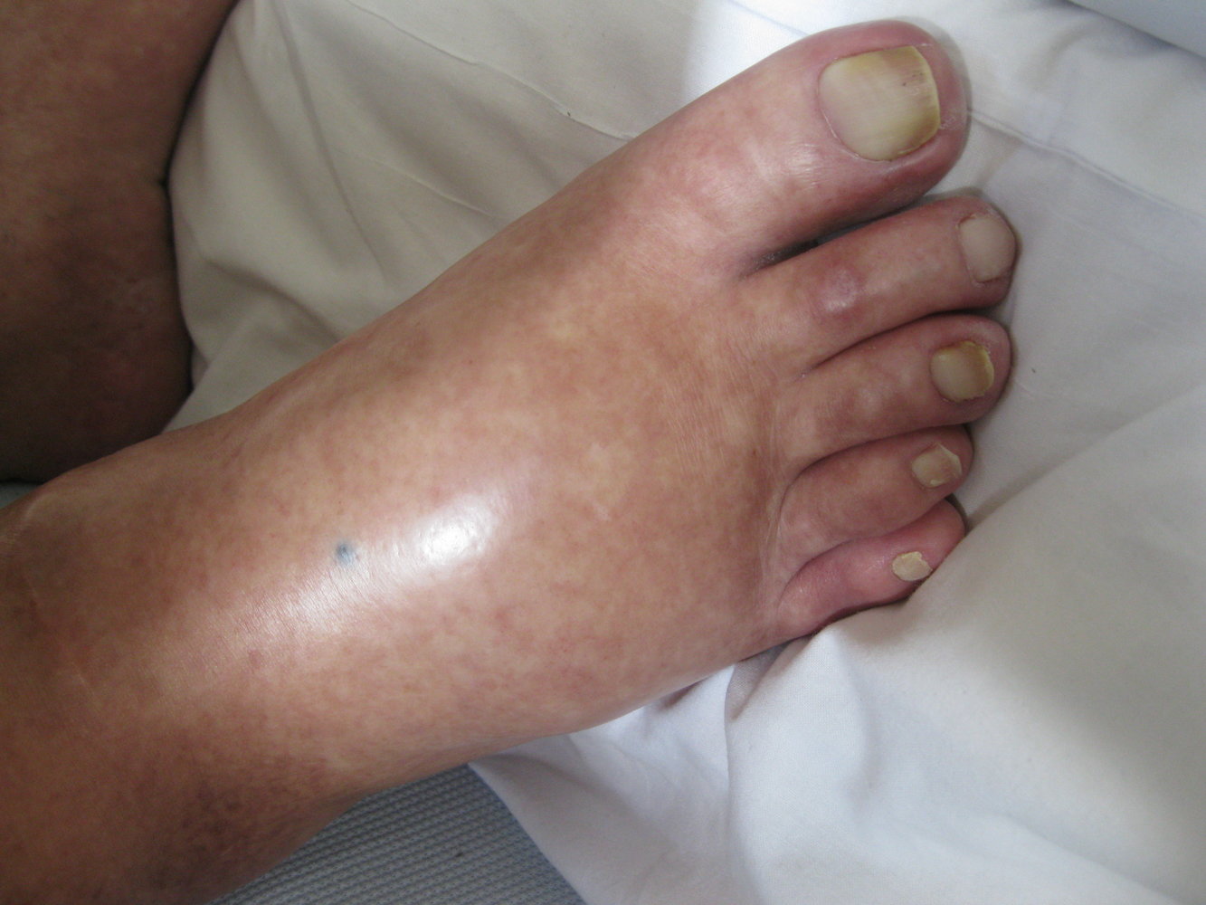 Edema