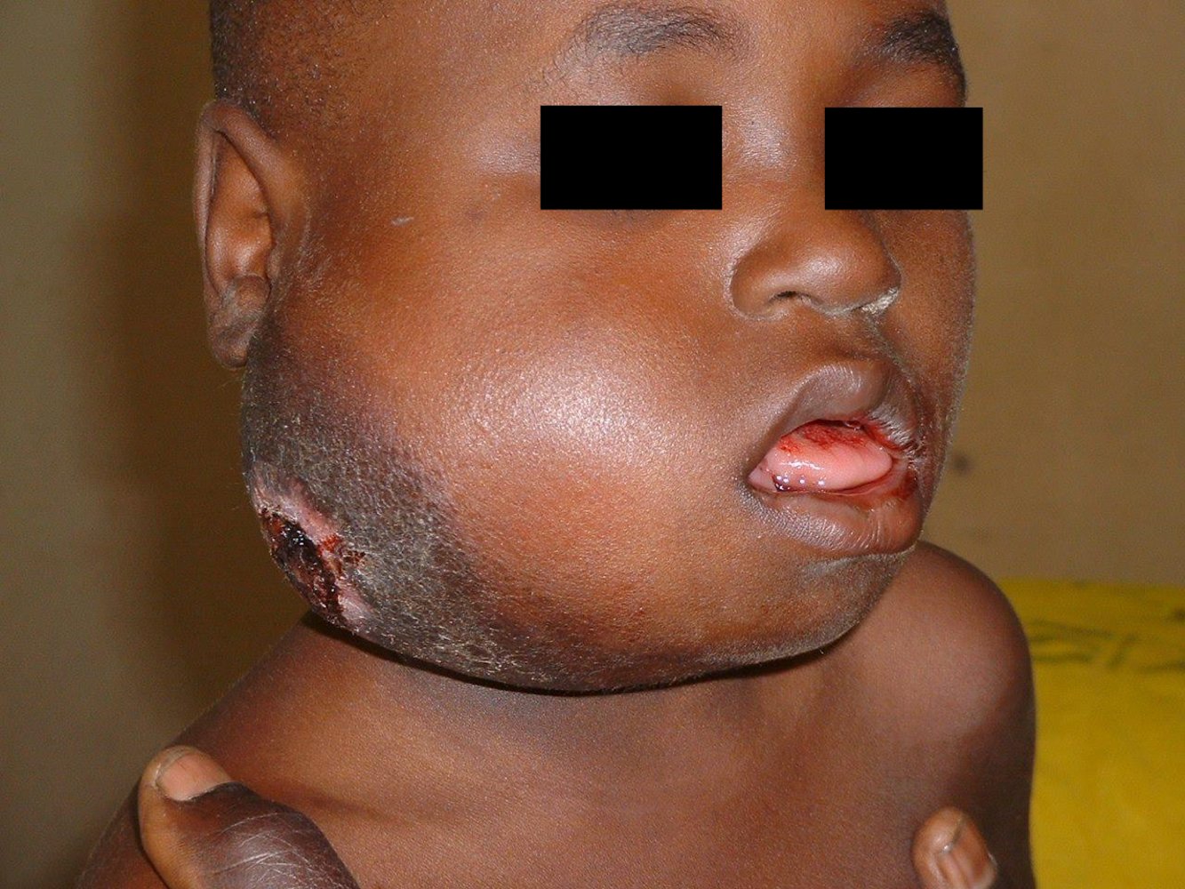 Burkitt lymphoma