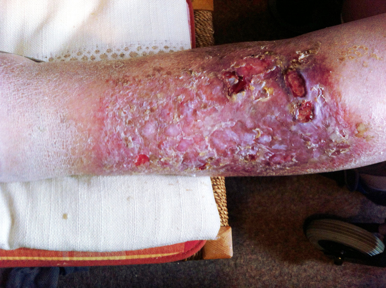Advanced chronic venous insufficiency