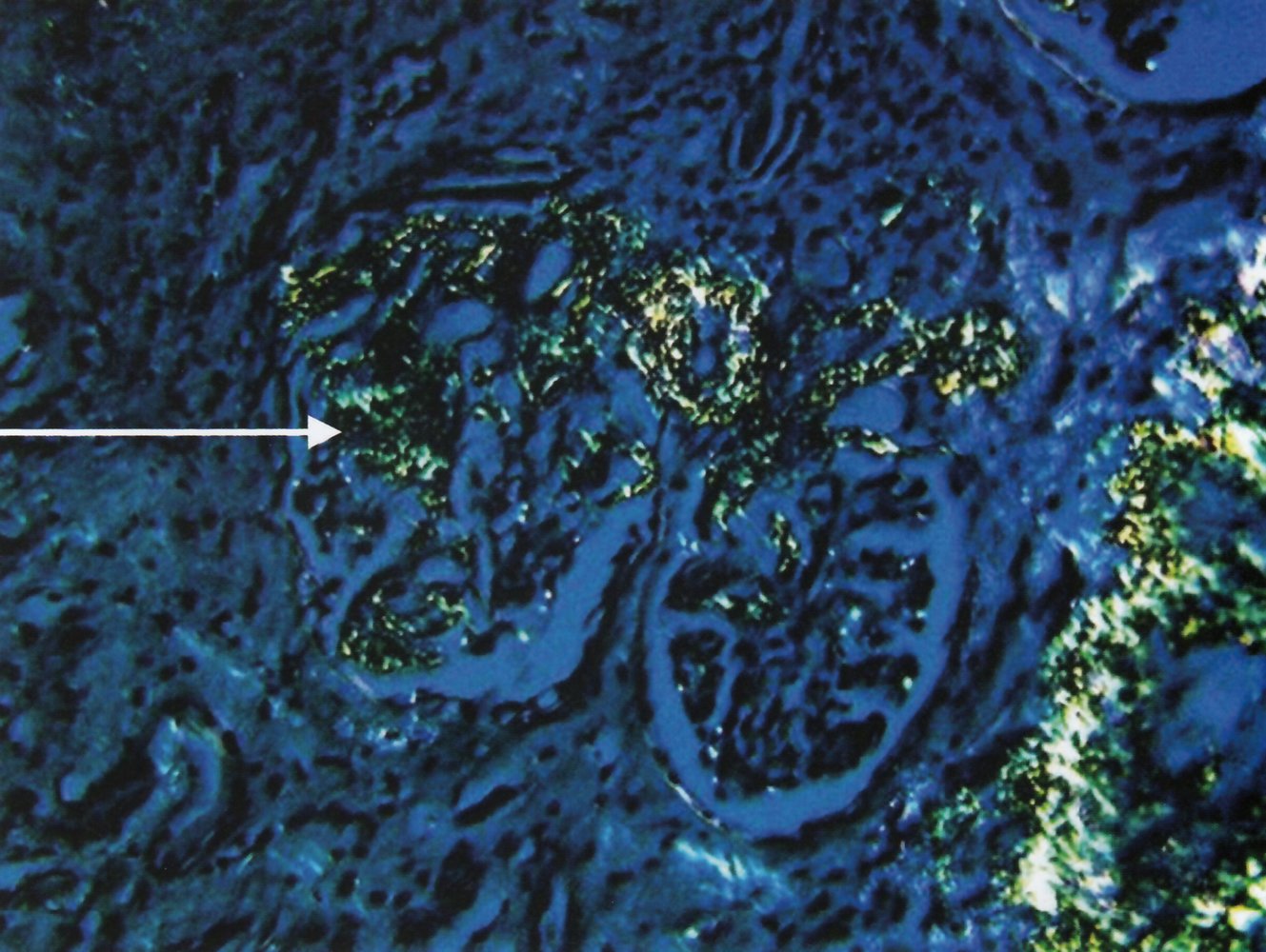 Kidney involvement in amyloidosis (2 of 2)