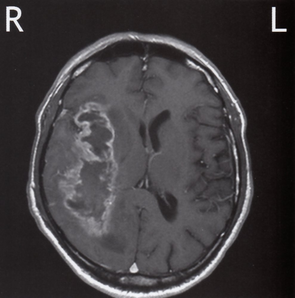 Glioblastoma multiforme (WHO grade IV astrocytoma)