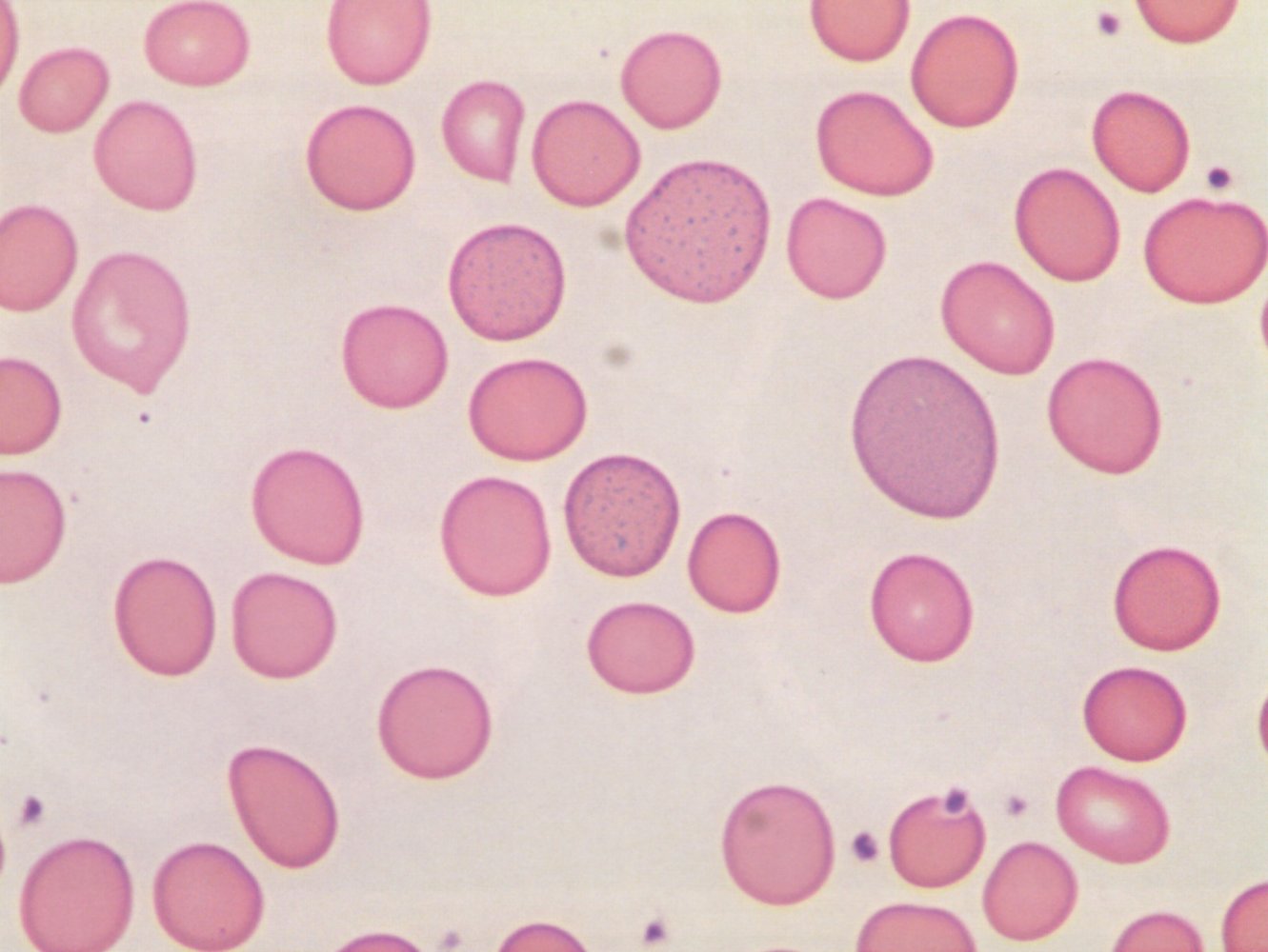 Basophilic stippling of erythrocytes