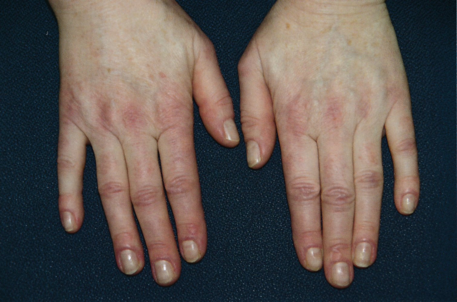 Gottron papules in dermatomyositis