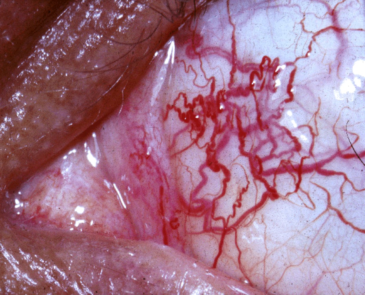 Ataxia telangiectasia