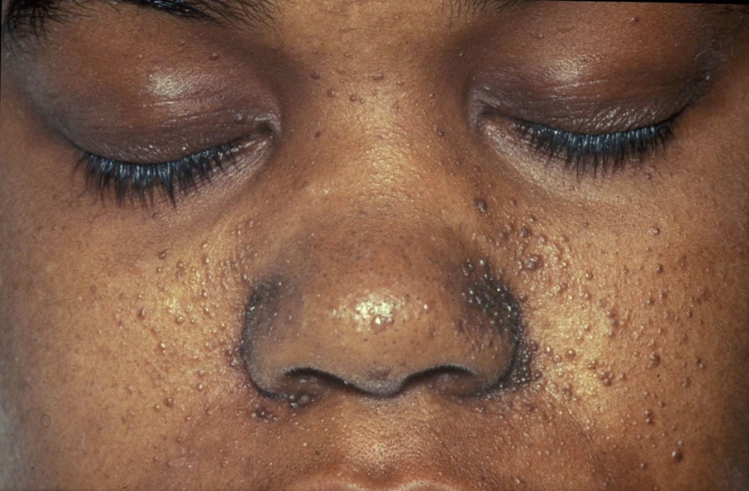 Adenoma sebaceum in patient with tuberous sclerosis