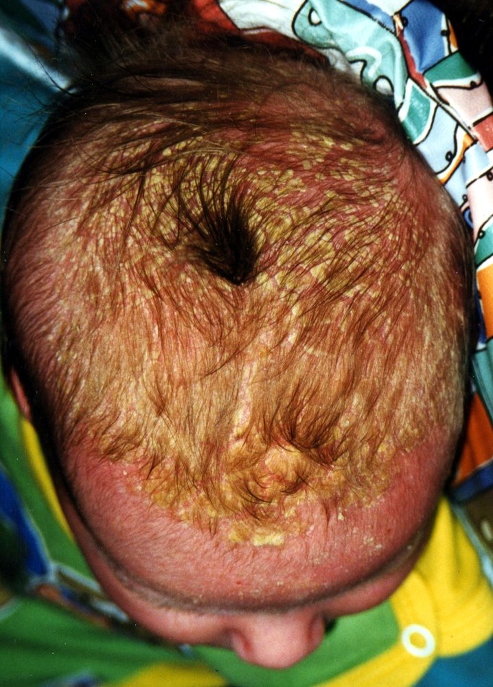 Infantile seborrheic dermatitis (cradle cap)