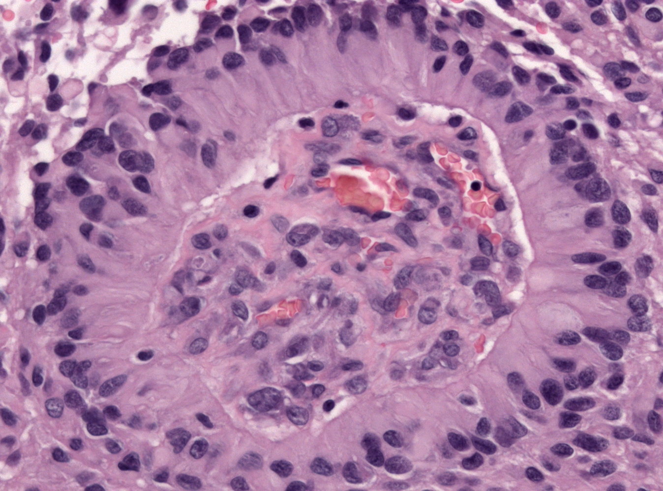 Ependymal pseudorosette