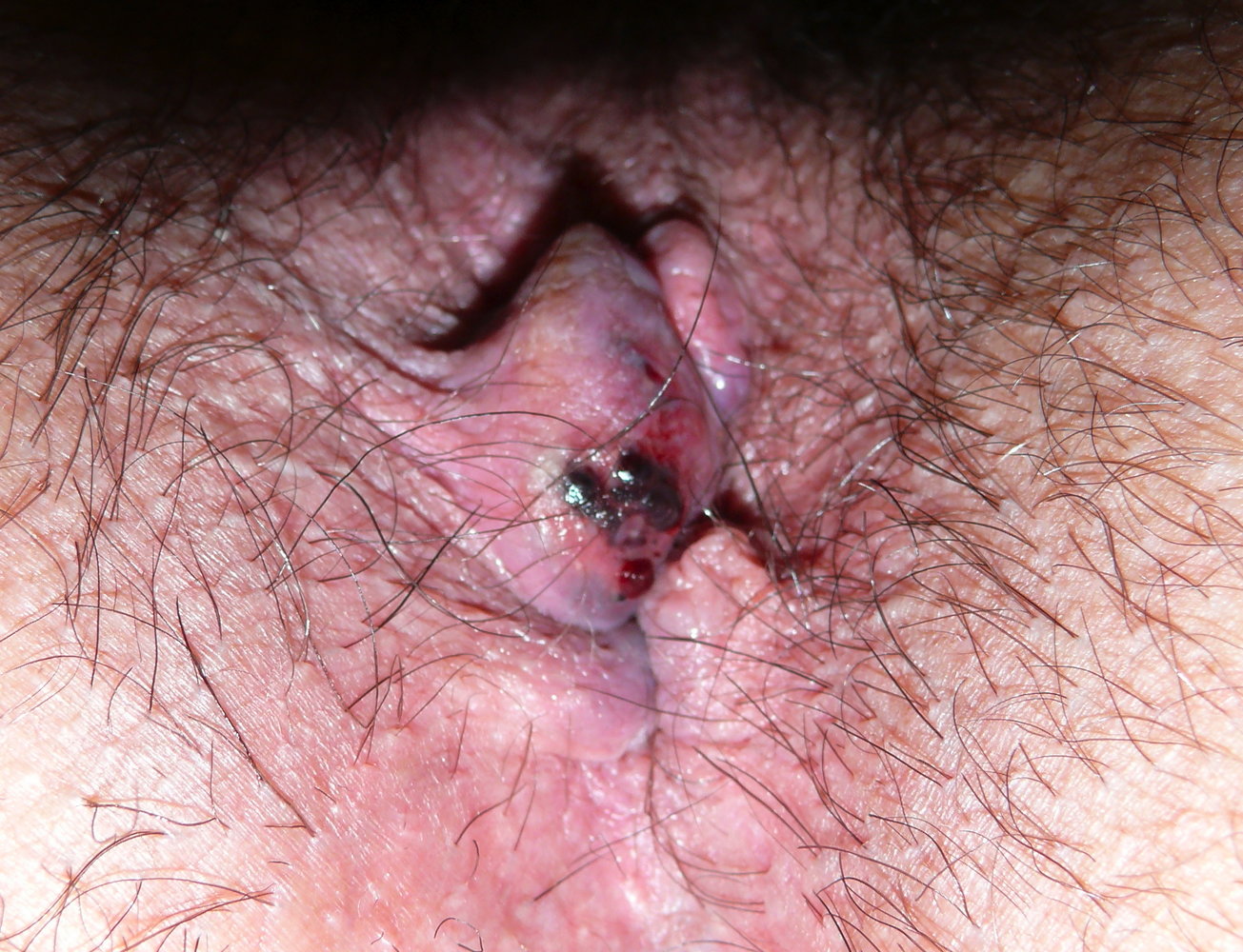 Thrombosed external hemorrhoid