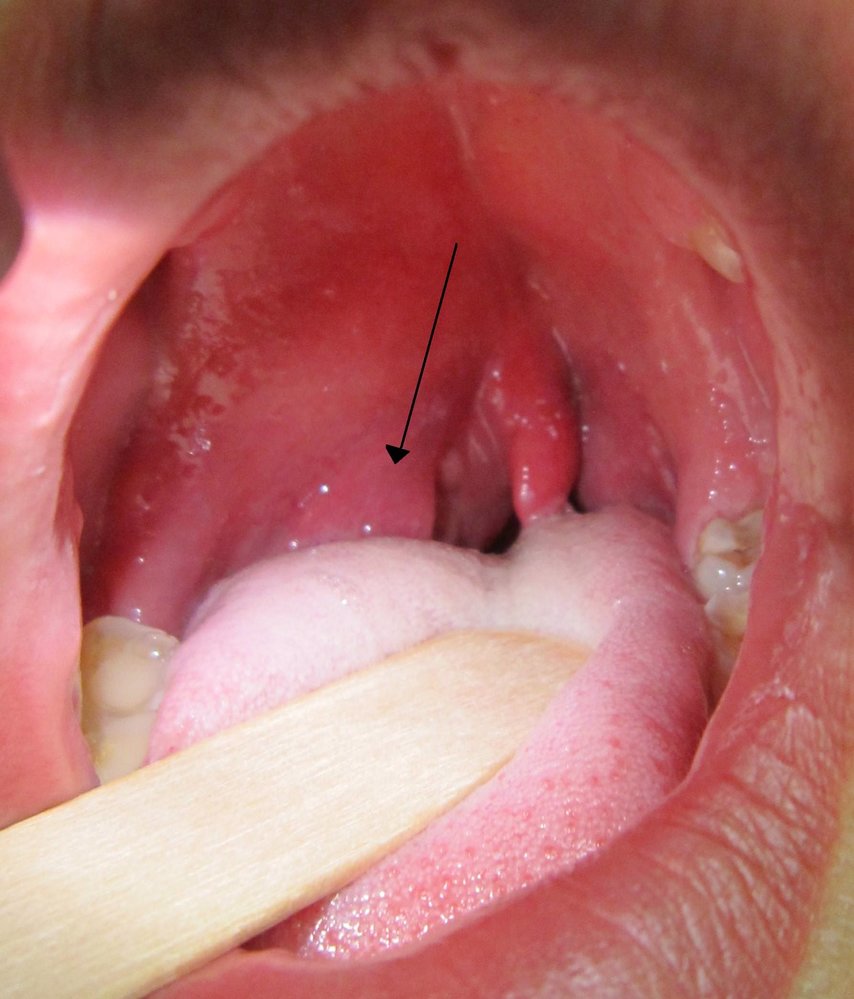 Peritonsillar abscess