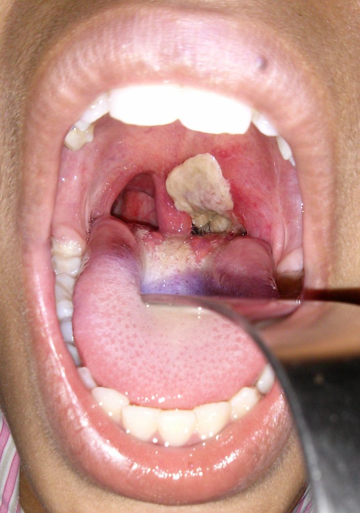 Tonsillar and pharyngeal diphtheria