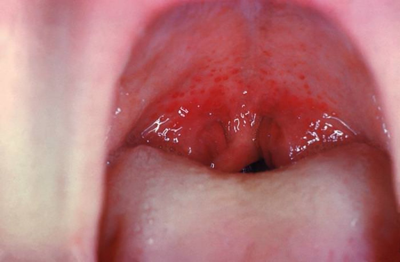 Acute tonsillopharyngitis
