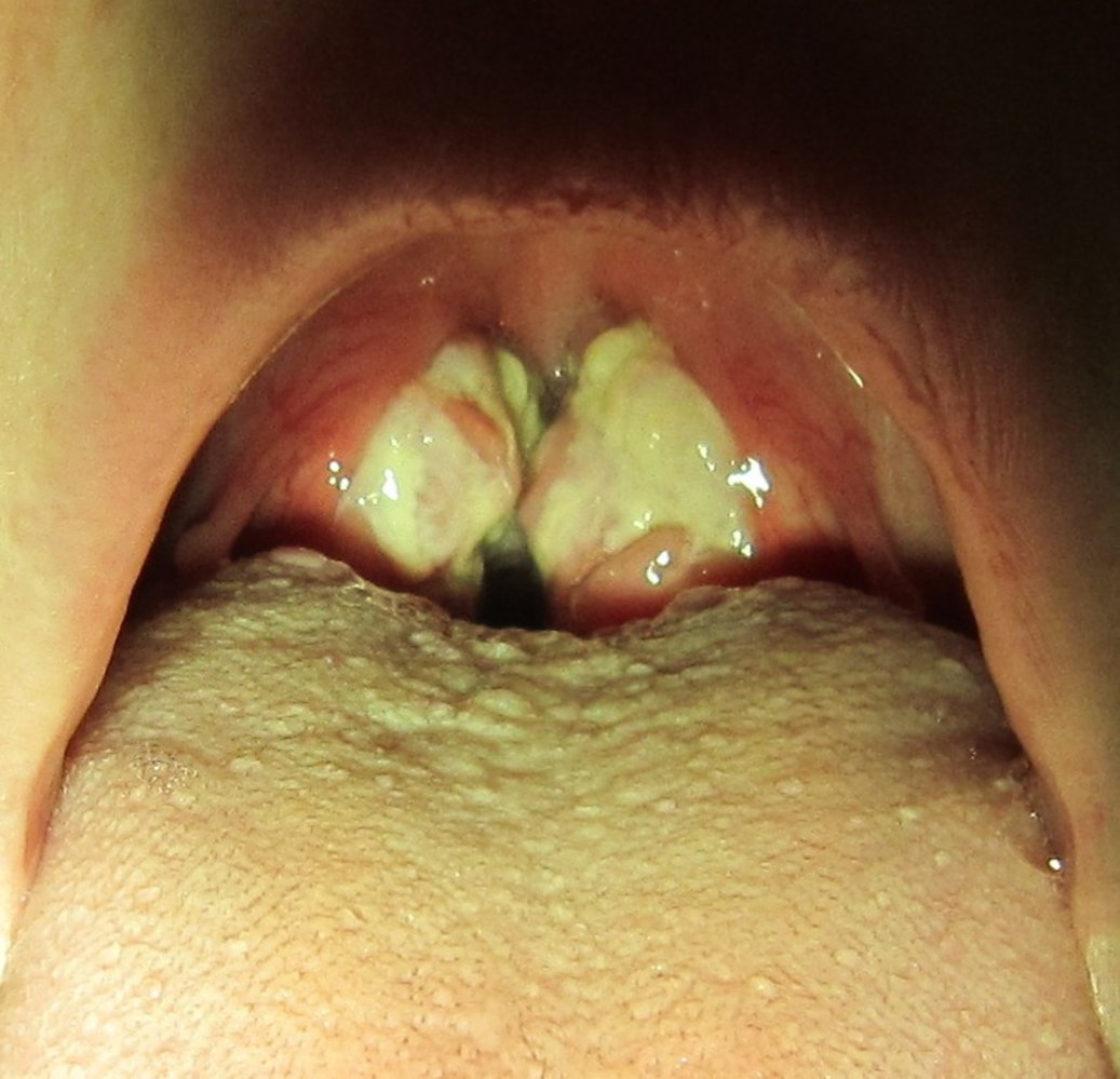 Exudative tonsillopharyngitis
