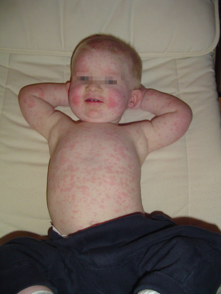 Erythema infectiosum