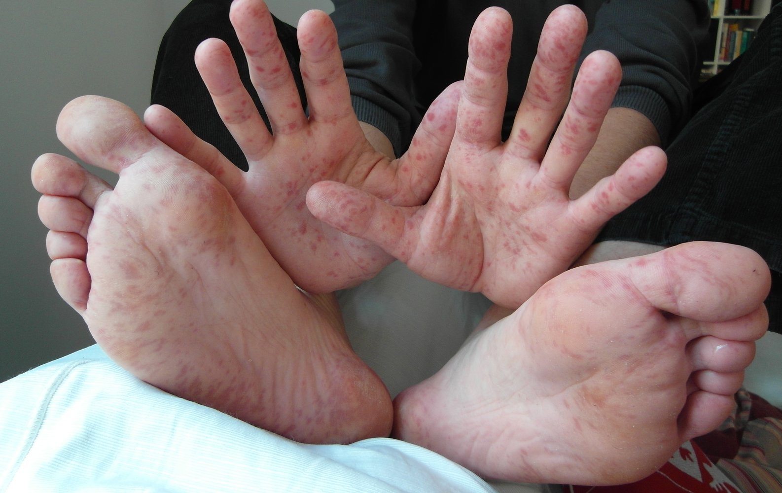 Hand, foot, and mouth disease