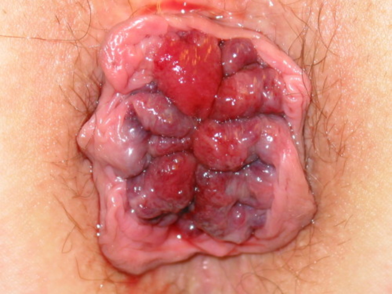 Grade IV hemorrhoids