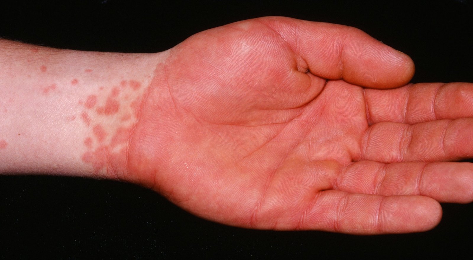 Papular-purpuric gloves-and-socks syndrome