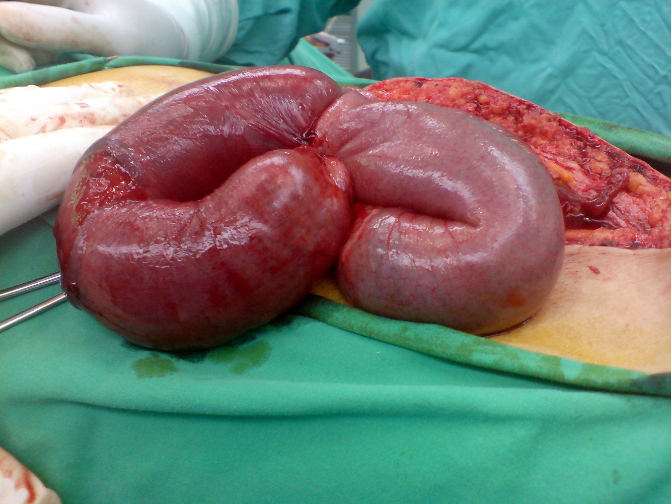 Strangulated bowel