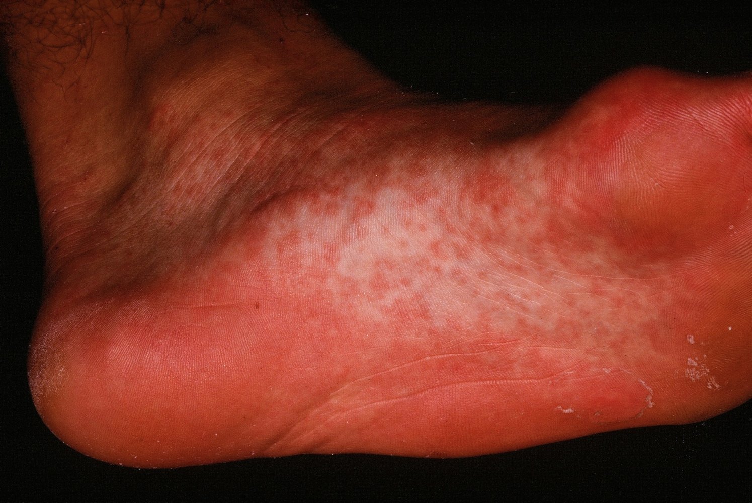 Papular-purpuric gloves-and-socks syndrome