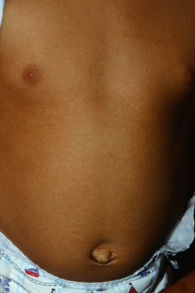 Scarlet fever rash